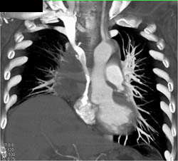 SVC Compression By Small Cell Lung Cancer - CTisus CT Scan