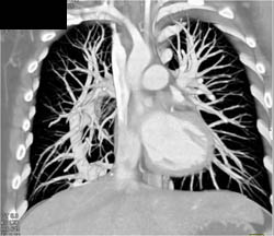 Anomalous Pulmonary Venous Return - CTisus CT Scan