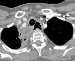 T-e Fistulae With Stent in Trachea - CTisus CT Scan