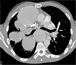 Pulmonary Aneurysms - CTisus CT Scan