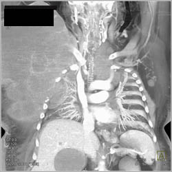 Mesothelioma Involves Chest Wall and Mediastinum. It Encases the Trachea - CTisus CT Scan