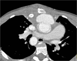 Pseudoaneurysm Off Ascending Aorta - CTisus CT Scan