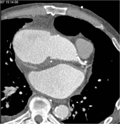 Pseudoaneurysm at Aortic Root at Surgical Site - CTisus CT Scan