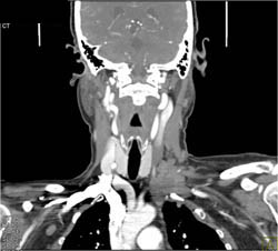 Asymmetric Jugular Veins - CTisus CT Scan