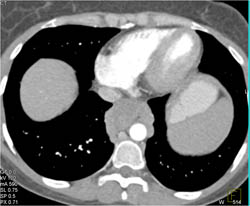 Esophageal Varices Simulate Posterior Mediastinal Nodes - CTisus CT Scan