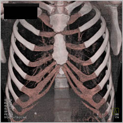 Pectus Deformity - CTisus CT Scan