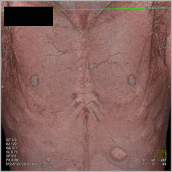 Pectus Deformity - CTisus CT Scan