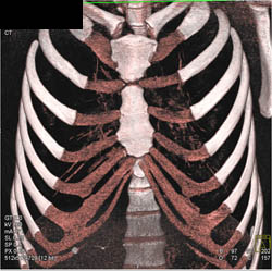 Pectus Deformity - CTisus CT Scan