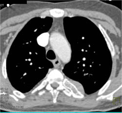 Extramedullary Hematopoiesis - CTisus CT Scan