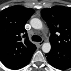 Clot in SVC Stent - CTisus CT Scan