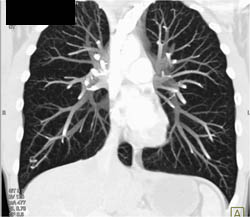 Pulmonary Arteriovenous Malformation (AVM)- Right Lower Lobe - CTisus CT Scan