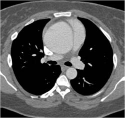 Type A Dissection - CTisus CT Scan