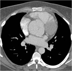 Type A Dissection - CTisus CT Scan