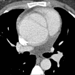 Type A Dissection - CTisus CT Scan