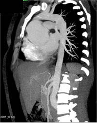 Type A Dissection - CTisus CT Scan