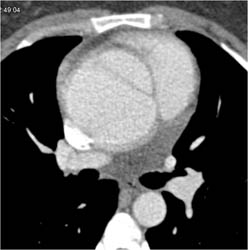 Type A Dissection - CTisus CT Scan