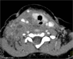 Abscess Extends From Neck Into the Mediastinum - CTisus CT Scan