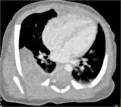 Sequestration - CTisus CT Scan