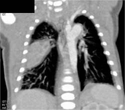 Sequestration - CTisus CT Scan