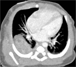 Sequestration - CTisus CT Scan