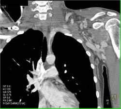 Arteriovenous Malformation (AVM) Left Axilla - CTisus CT Scan