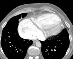 Large Right Ventricle - CTisus CT Scan