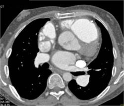 Persistent Left Superior Vena Cava (SVC) Drains Into the Coronary Sinus and Enlarged Pulmonary Artery - CTisus CT Scan