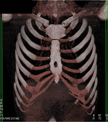 Pectus Deformity - CTisus CT Scan