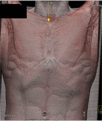 Pectus Deformity - CTisus CT Scan