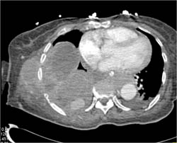 Active Bleed Right Pleural Space Following A Biopsy - CTisus CT Scan