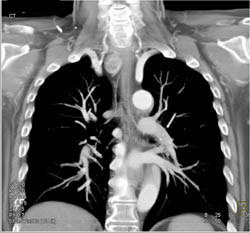 Substernal Thyroid Pushes on the Airway - CTisus CT Scan