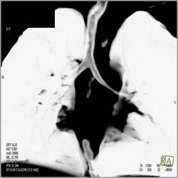 Stenosis of the Left Mainstem Bronchus - CTisus CT Scan