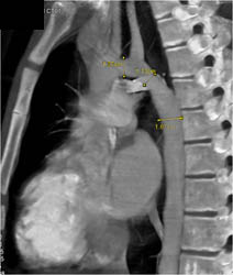 S/P Repair of Coa - CTisus CT Scan