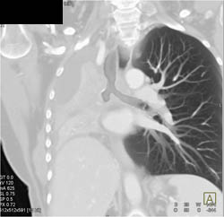 Occlusion of Right Mainstem Bronchus By Carcinoid Tumor - CTisus CT Scan