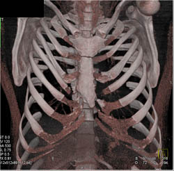 Pectus Deformity - CTisus CT Scan