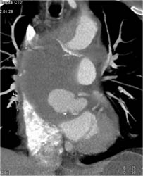 Repair of Type A Dissection - CTisus CT Scan