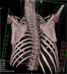 Scoliosis - CTisus CT Scan