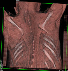 Tracheal Compression By Aorta - CTisus CT Scan