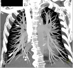 Prior Embolization of Pulmonary Arteriovenous Malformations (PAVMs) - CTisus CT Scan