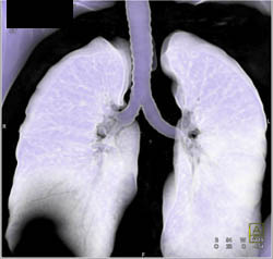 Virtual Bronchoscopy With Thickening of Bronchi to the Right Lower Lung - CTisus CT Scan