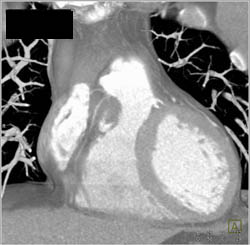 Dilated Aortic Root - CTisus CT Scan