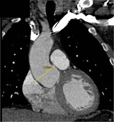 Dilated Aortic Root - CTisus CT Scan