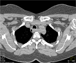 Aberrant Left Subclavian Artery - CTisus CT Scan