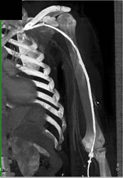 Normal Brachial and Axillary Artery - CTisus CT Scan