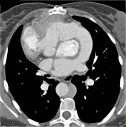 Situs Inversus - CTisus CT Scan