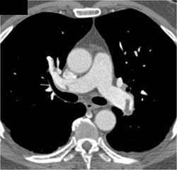 Pulmonary Embolism - CTisus CT Scan