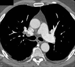 Pulmonary Embolism - CTisus CT Scan