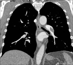 Pulmonary Embolism - CTisus CT Scan