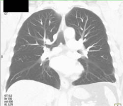 Pulmonary Embolism - CTisus CT Scan