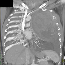 Sarcoma Involves Multiple Ribs - CTisus CT Scan